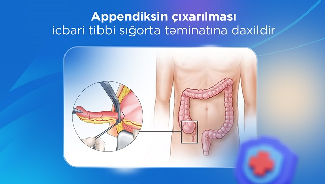 Appendiksin çıxarılması icbari tibbi sığorta təminatına daxildir